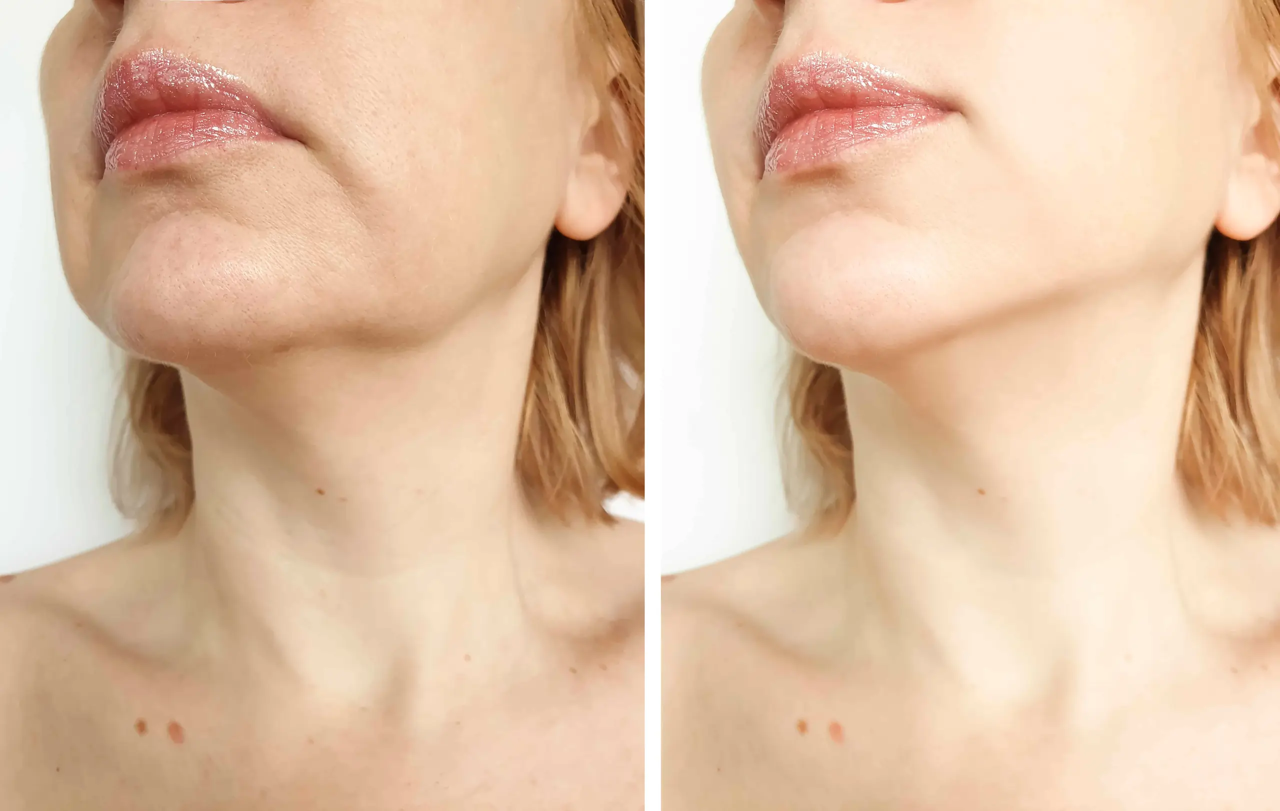 Ultherapy Before & After Treatment in Michigan