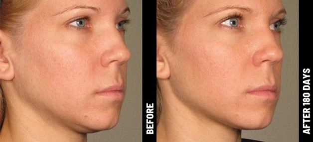 Ultherapy Before & After Treatment Pic in Michigan