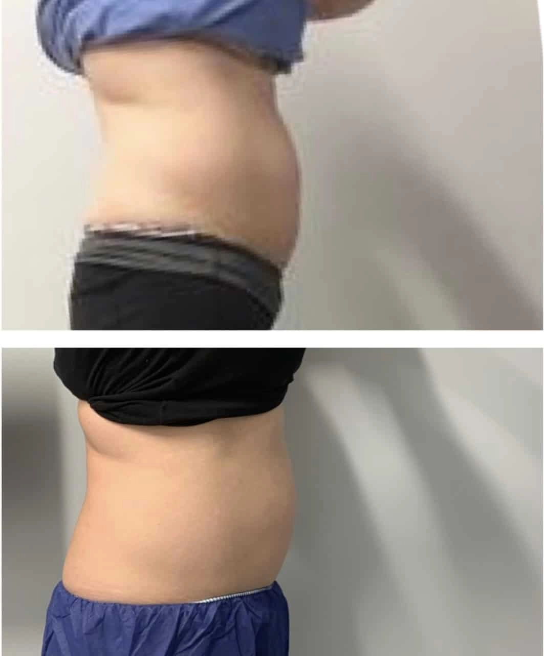 Before & After Vanquish Treatment in Michigan