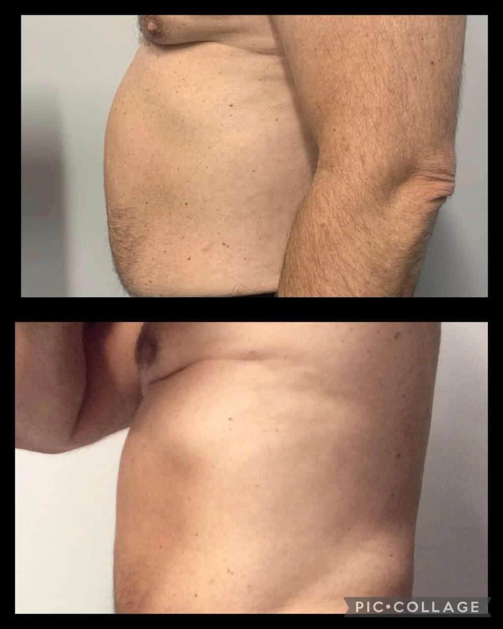Before & After Vanquish Treatment Images in Michigan
